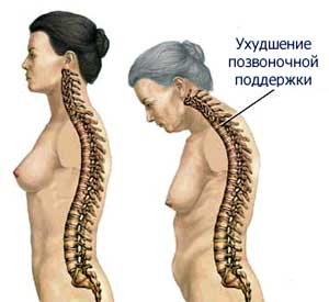 Первичный (старческий) остепороз