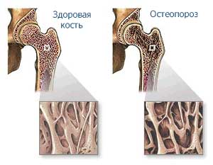 Остеопороз