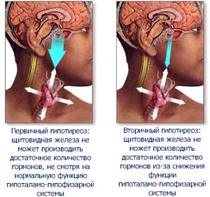 Первичный и вторичный гипотиреоз