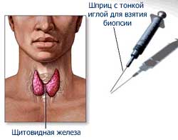 Пункция щитовидной железы
